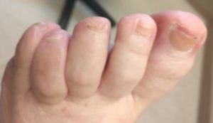 Toenail Fungus Tea Tree Oil Cure