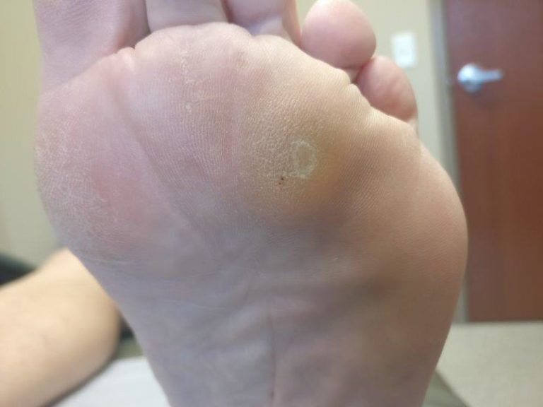 foot corn contagious