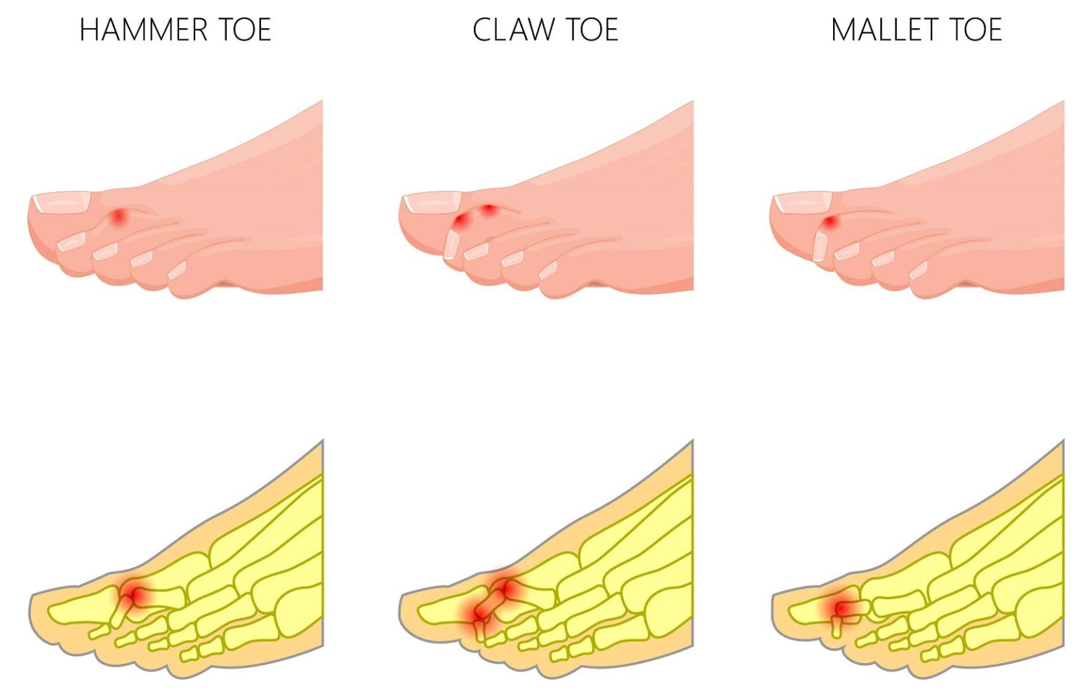 Pain in the Small Toes #1 Best Causes, Symptoms & Treatment